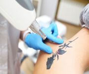 Laser Tattoo Removal Clinic – Offers Invited